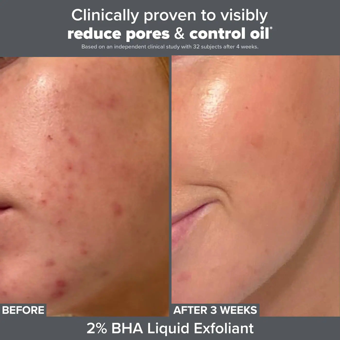 Paula's Choice - Smooth & Glow Exfoliating Duo for Clear and Brighter looking skin