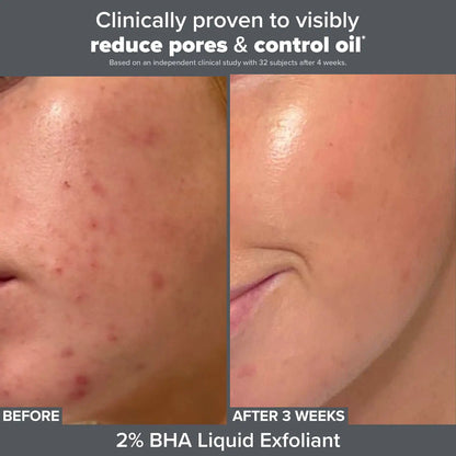 Paula's Choice - Smooth & Glow Exfoliating Duo for Clear and Brighter looking skin